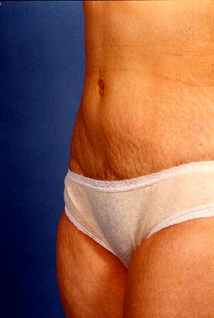 ABDOMINOPLASTY - AFTER