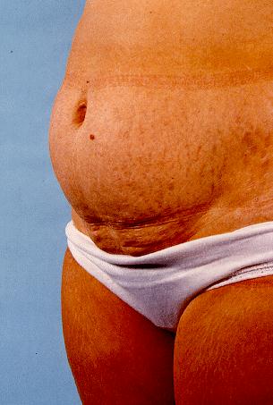 ABDOMINOPLASTY - BEFORE