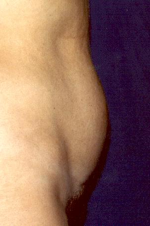 ABDOMINOPLASTY - BEFORE