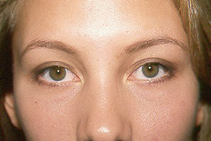 UPPER BLEPHAROPLASTY - AFTER