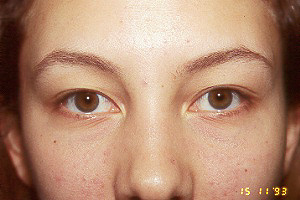 UPPER BLEPHAROPLASTY - BEFORE