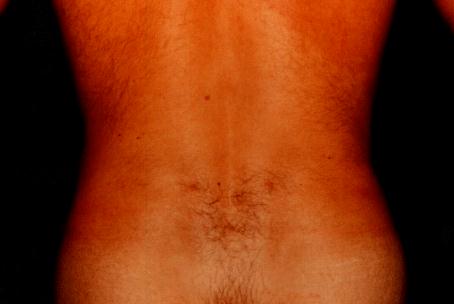 FLANK LIPOSUCTION - AFTER