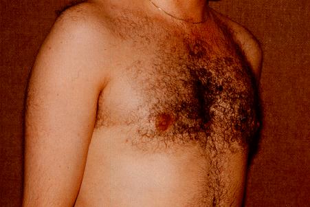 GYNECOMASTIA - AFTER