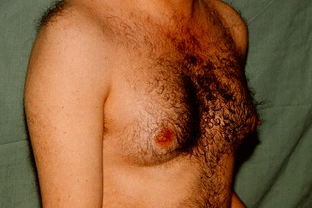 GYNECOMASTIA - BEFORE