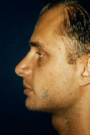 RHINOPLASTY - AFTER