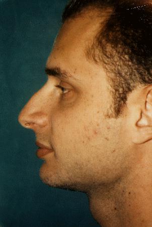 RHINOPLASTY - BEFORE