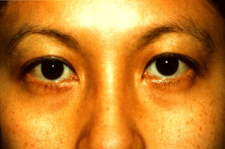 UPPER EYELIDS - BEFORE