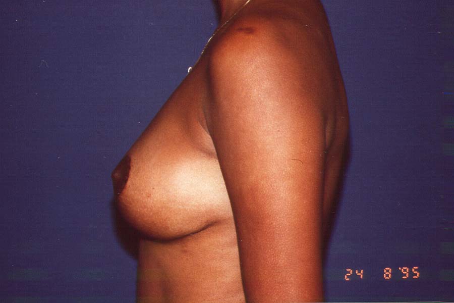 AFTER BREAST LIFT