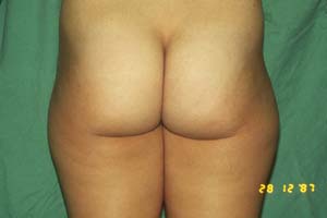 LIPOSUCTION - BEFORE