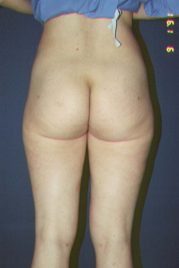 LIPOSUCTION - AFTER