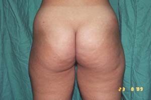 LIPOSUCTION - BEFORE